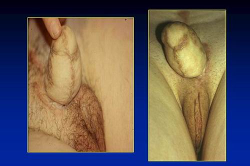 la clitoridopessia alla base del neo pene (sec.Austoni 1990) — Disturbi di Genere