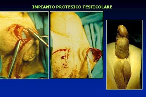 la clitoridopessia alla base del neo pene (sec.Austoni 1990) — Disturbi di Genere