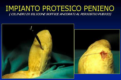 la clitoridopessia alla base del neo pene (sec.Austoni 1990) — Disturbi di Genere