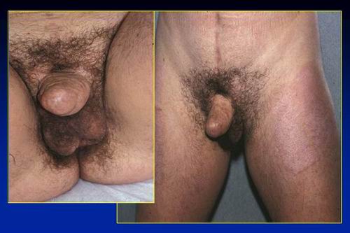 la clitoridopessia alla base del neo pene (sec.Austoni 1990) — Disturbi di Genere