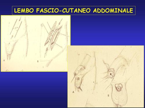 Lo schema ed alcune foto intraoperatorie del lembo addominale di Pryor — Falloplastica