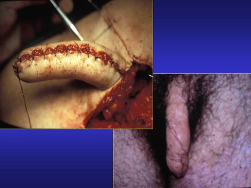 Lo schema ed alcune foto intraoperatorie del lembo addominale di Pryor — Falloplastica