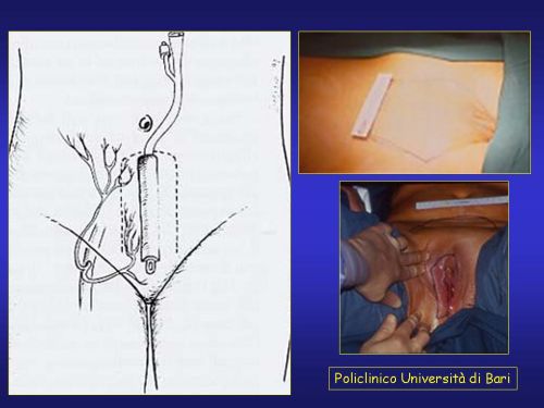 Lo schema ed alcune foto intraoperatorie del lembo addominale di Pryor — Falloplastica