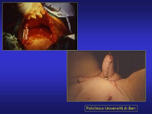 Lo schema ed alcune foto intraoperatorie del lembo addominale di Pryor — Falloplastica
