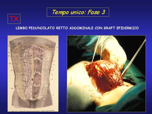 Falloplastica — figura 12