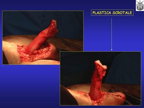 Falloplastiche parziali — Falloplastica