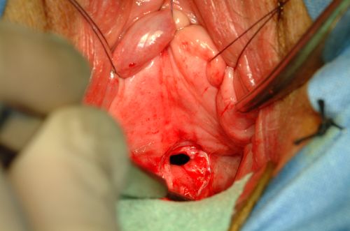 Riparazione delle fistole vescica-vaginali — figura 14