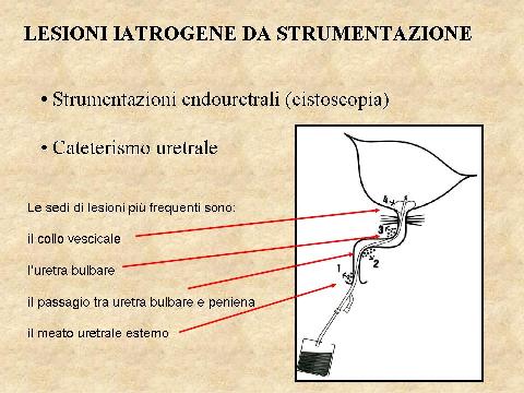 Stenosi uretrali — figura 11