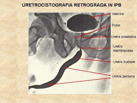 Stenosi uretrali — figura 13