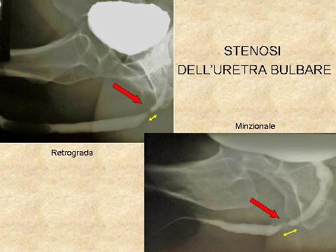 Stenosi uretrali — figura 15