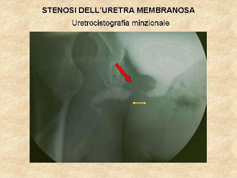 Stenosi uretrali — figura 14