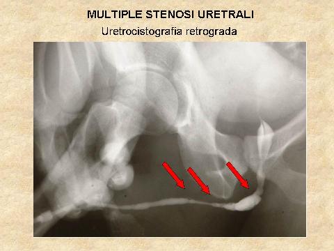 Uretrocistografia retrograda e minzionale — Stenosi uretrali