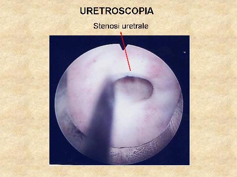 Uretrocistoscopia — Stenosi uretrali