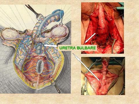 POSTERIORE: Membranosa, Prostatica — Stenosi uretrali