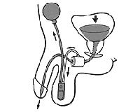 Urodinamica — figura 22