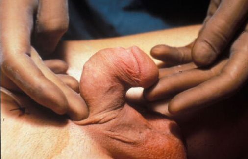 Riparazione in due tempi — Malformazioni congenite
