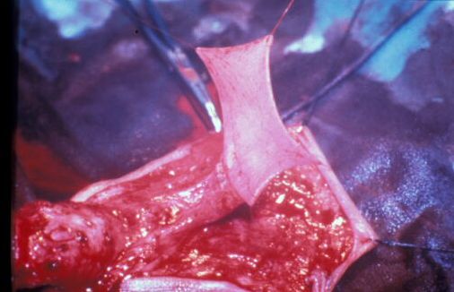 Micropene — Malformazioni congenite