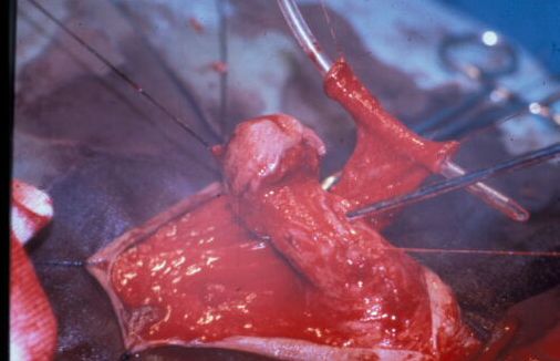 Micropene — Malformazioni congenite