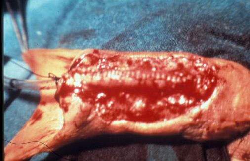 Micropene — Malformazioni congenite