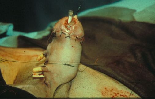 Micropene — Malformazioni congenite