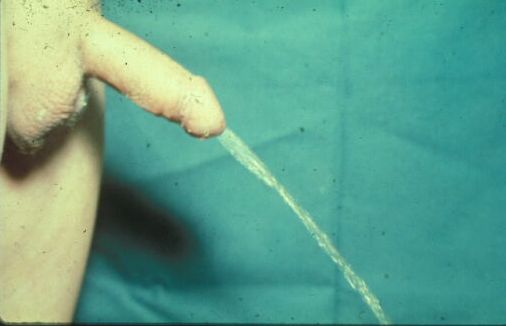 Micropene — Malformazioni congenite
