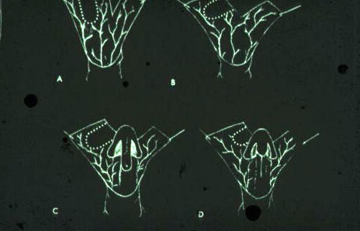 Micropene — Malformazioni congenite
