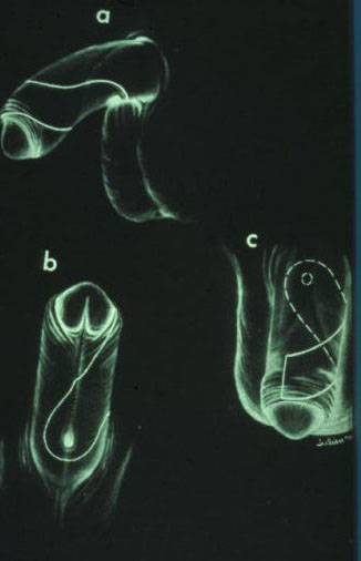 Micropene — Malformazioni congenite