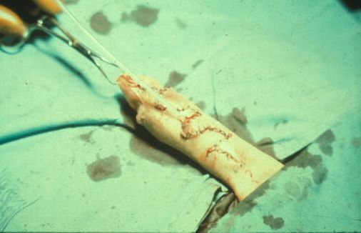 Innesto libero di mucosa — Malformazioni congenite