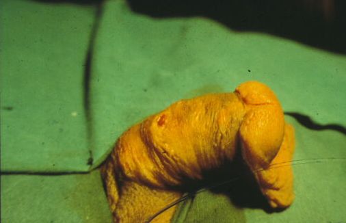 Innesto libero di mucosa — Malformazioni congenite