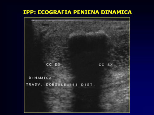 Quali esami sono necessari per diagnosticare l'IPP ? — Pene Curvo – Malattia di La Peyronie