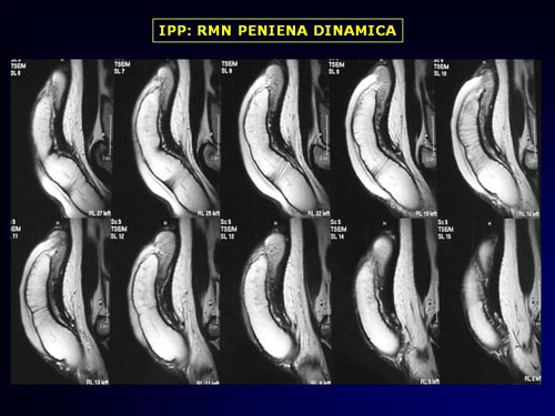 Quali esami sono necessari per diagnosticare l'IPP ? — Pene Curvo – Malattia di La Peyronie