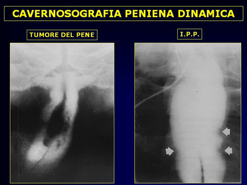Quali esami sono necessari per diagnosticare l'IPP ? — Pene Curvo – Malattia di La Peyronie
