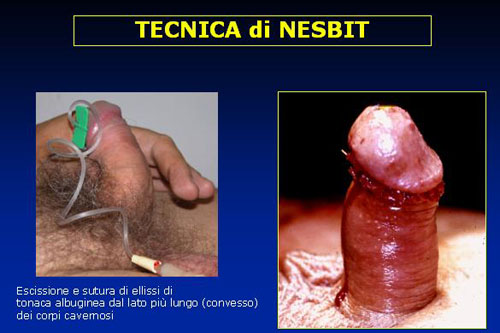 Tecniche di raddrizzamento semplici — Pene Curvo – Malattia di La Peyronie