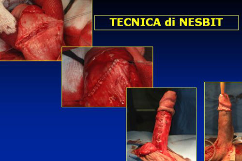 Tecniche di raddrizzamento semplici — Pene Curvo – Malattia di La Peyronie