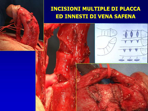 Incisioni della placca e graft sefenici di copertura (sec.Austoni 1) — Pene Curvo – Malattia di La Peyronie