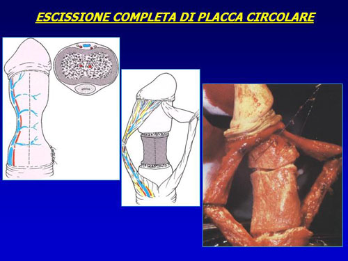 Asportazione completa della placca + innesti liberi o vascolarizzati — Pene Curvo – Malattia di La Peyronie