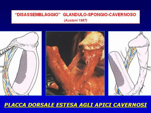 Asportazione completa della placca + innesti liberi o vascolarizzati — Pene Curvo – Malattia di La Peyronie