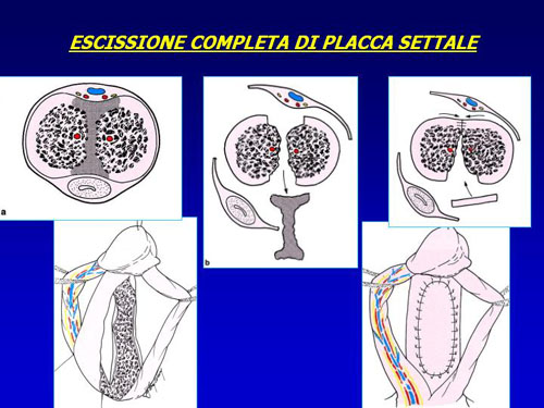 Asportazione completa della placca + innesti liberi o vascolarizzati — Pene Curvo – Malattia di La Peyronie