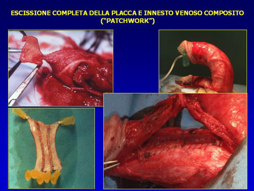 Asportazione completa della placca + innesti liberi o vascolarizzati — Pene Curvo – Malattia di La Peyronie