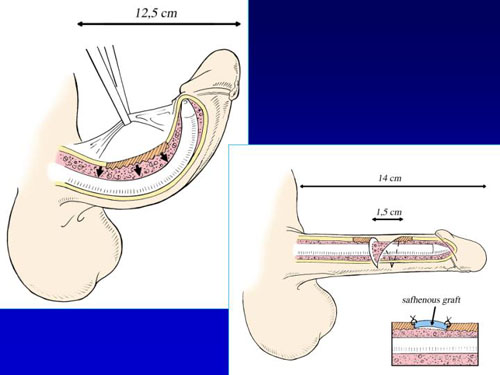 Asportazione completa della placca + innesti liberi o vascolarizzati — Pene Curvo – Malattia di La Peyronie