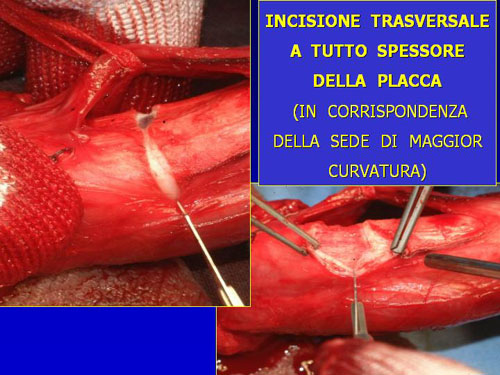 Asportazione completa della placca + innesti liberi o vascolarizzati — Pene Curvo – Malattia di La Peyronie