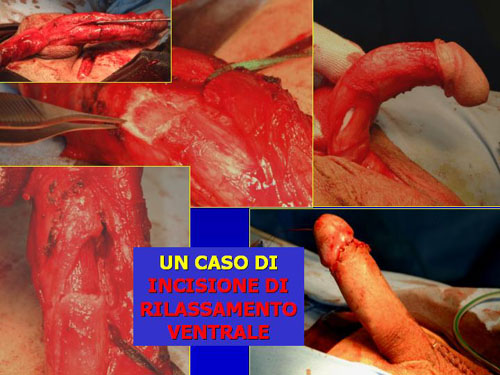 Asportazione completa della placca + innesti liberi o vascolarizzati — Pene Curvo – Malattia di La Peyronie