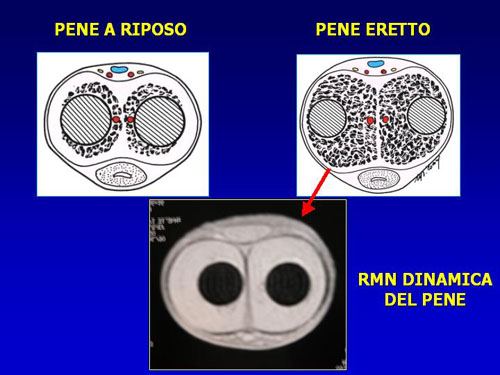 Asportazione completa della placca + innesti liberi o vascolarizzati — Pene Curvo – Malattia di La Peyronie