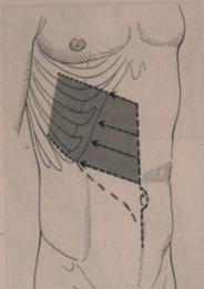 Terapia del tumore del rene — figura 21