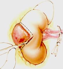 Terapia del tumore del rene — figura 25