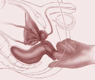 Diagnosi — Terapia del tumore prostatico