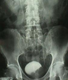 Terapia del tumore della vescica — figura 2