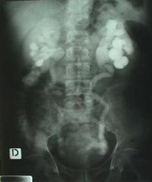 Terapia del tumore della vescica — figura 3