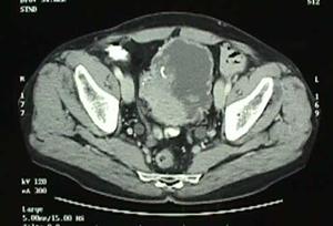 Terapia del tumore della vescica — figura 5