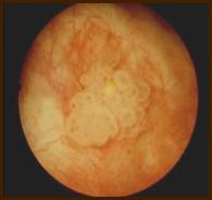 Terapia del tumore della vescica — figura 7